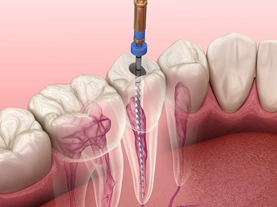 10. Root canal treatment