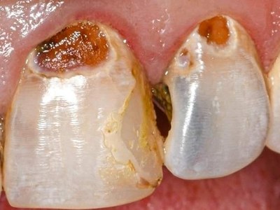 11. Dental Restorations