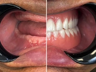 12. Full mouth rehabilitation