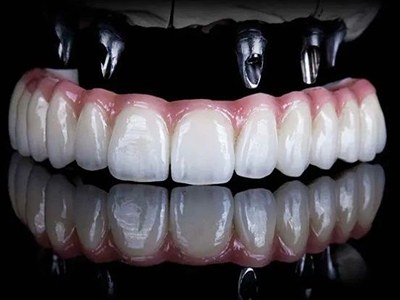 13. Implant supported full mouth rehabilitation