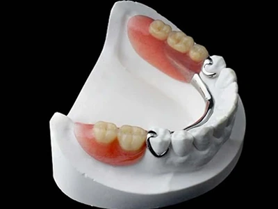 2. Removable Partial Denture and Cast Partial Denture