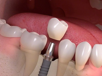 6. Dental Implants