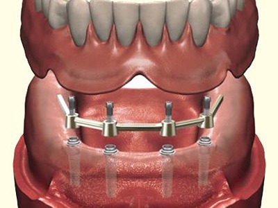 7. Implant overdentures