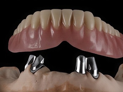 8. Tooth supported overdentures