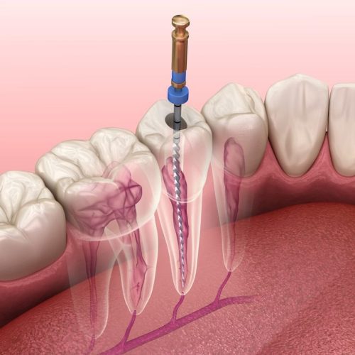 10. Root canal treatment