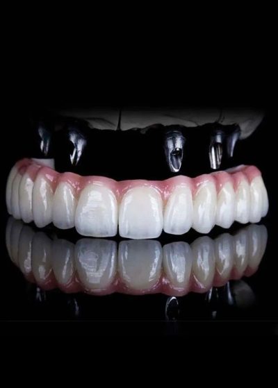 13. Implant supported full mouth rehabilitation