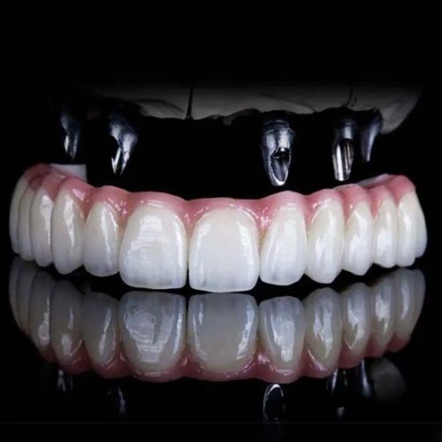 13. Implant supported full mouth rehabilitation