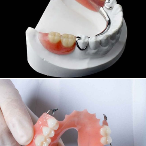 2. Removable Partial Denture and Cast Partial Denture