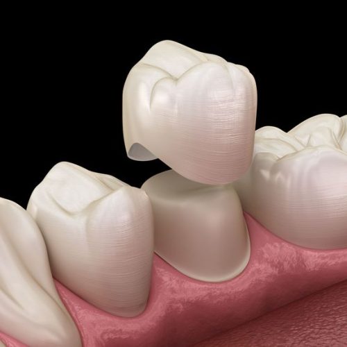3.-Dental-Crown