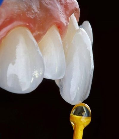 5. Dental Veneers