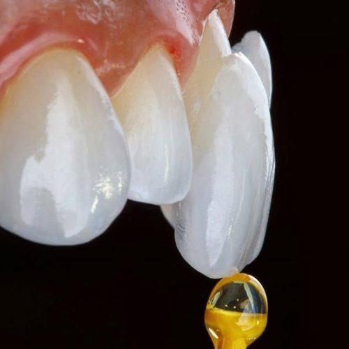 5. Dental Veneers