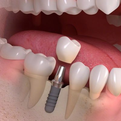6. Dental Implants