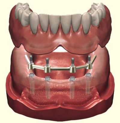 7. Implant overdentures