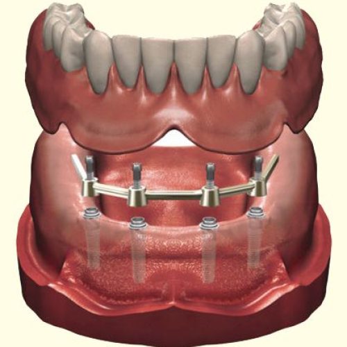 7. Implant overdentures