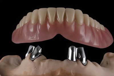 8. Tooth supported overdentures-scaled
