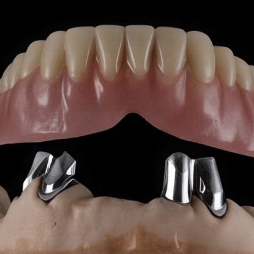 8. Tooth supported overdentures-scaled